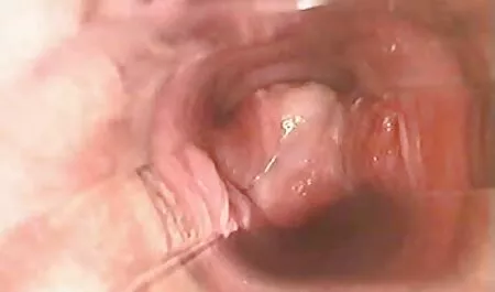 Ein Mann griff wiede ...